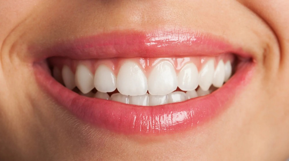 Close de sorriso feminino com dentes brancos e alinhados após procedimento de clareamento dental em Jundiaí na Oral Mac.