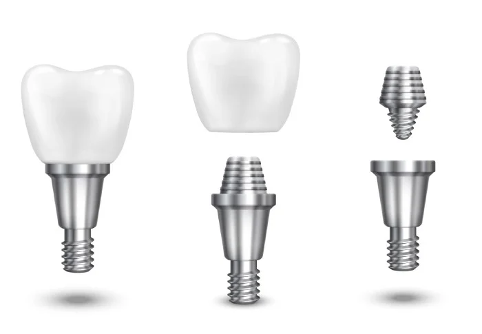 Esquema didático mostrando as partes de um implante dentário: o pino de titânio, o componente protético e a coroa cerâmica na Oral Mac em Jundiaí.
