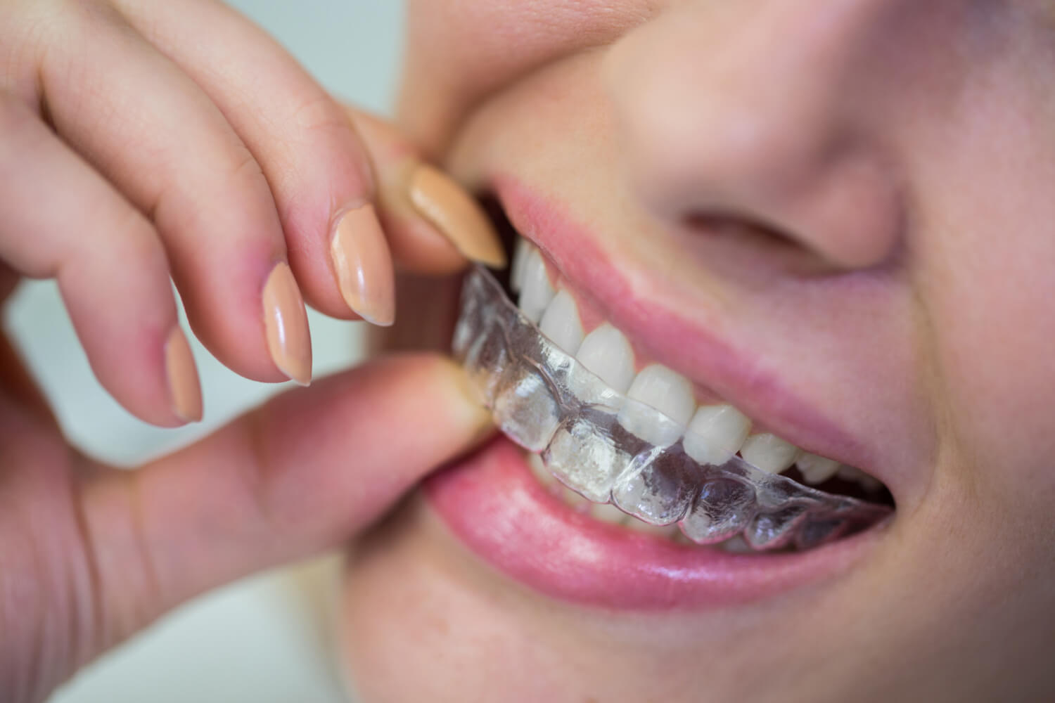 Close de pessoa removendo o alinhador invisível transparente, destacando a liberdade para comer durante o tratamento em Jundiaí na Oral Mac